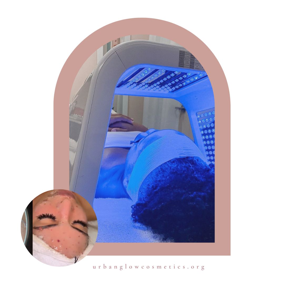 Advanced Acne Facial Urban Glow Cosmetics